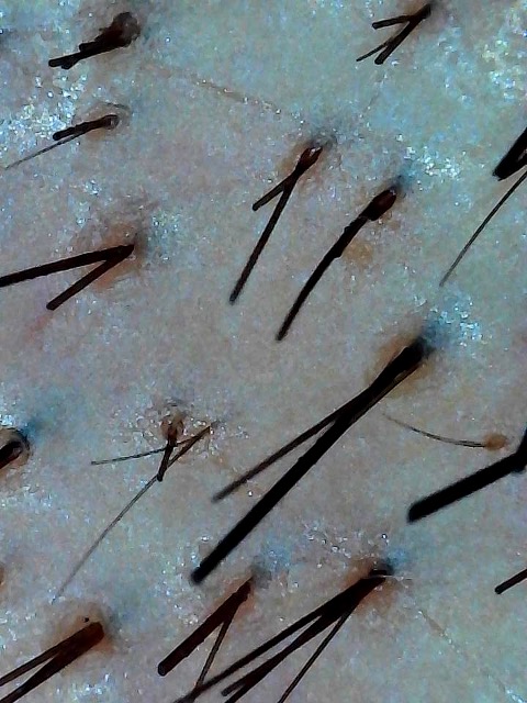 Tricoscopia — densidad y unidades foliculares